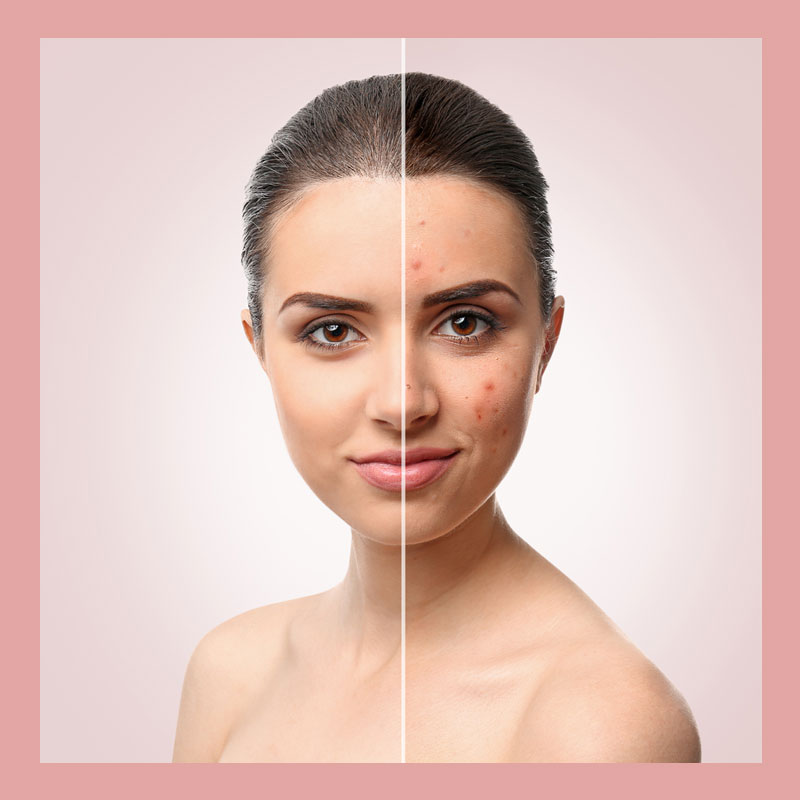 Młoda kobieta prezentująca efekty zabiegu przeciwtrądzikowego.